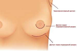 Установка имплантов и подтяжка груди с доступом через ареолу