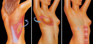 Методы пластики груди